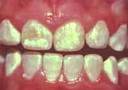 fluorosis 2