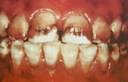 fluorosis 1